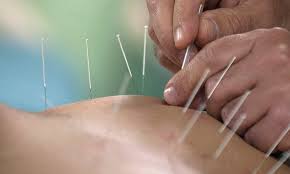 Acupuncture